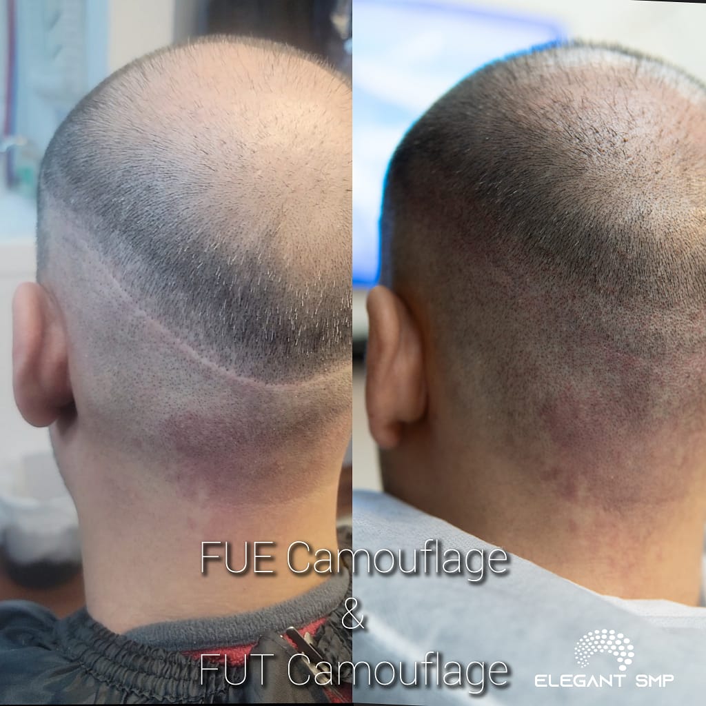 FUE & FUT scars camouflaged with scalp micropigmentation