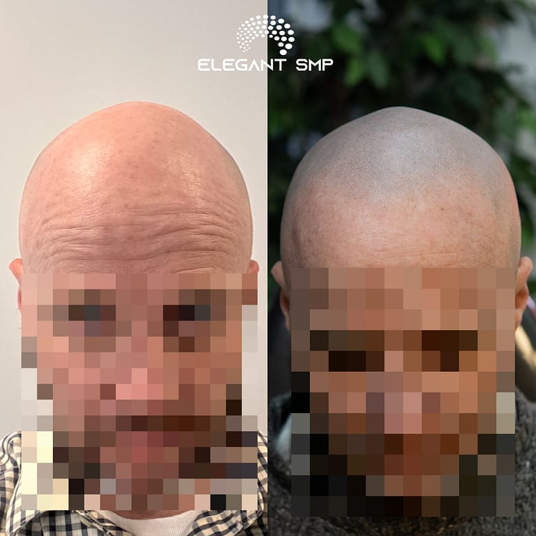 Completely healed scalp micropigmentation results in Buffalo, NY