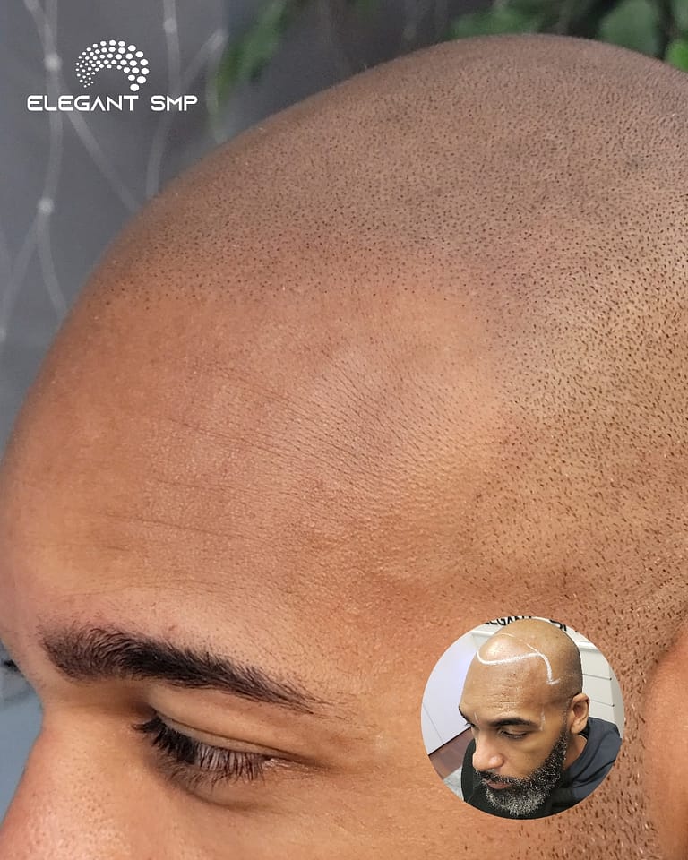 Scalp Micropigmentation Before/After