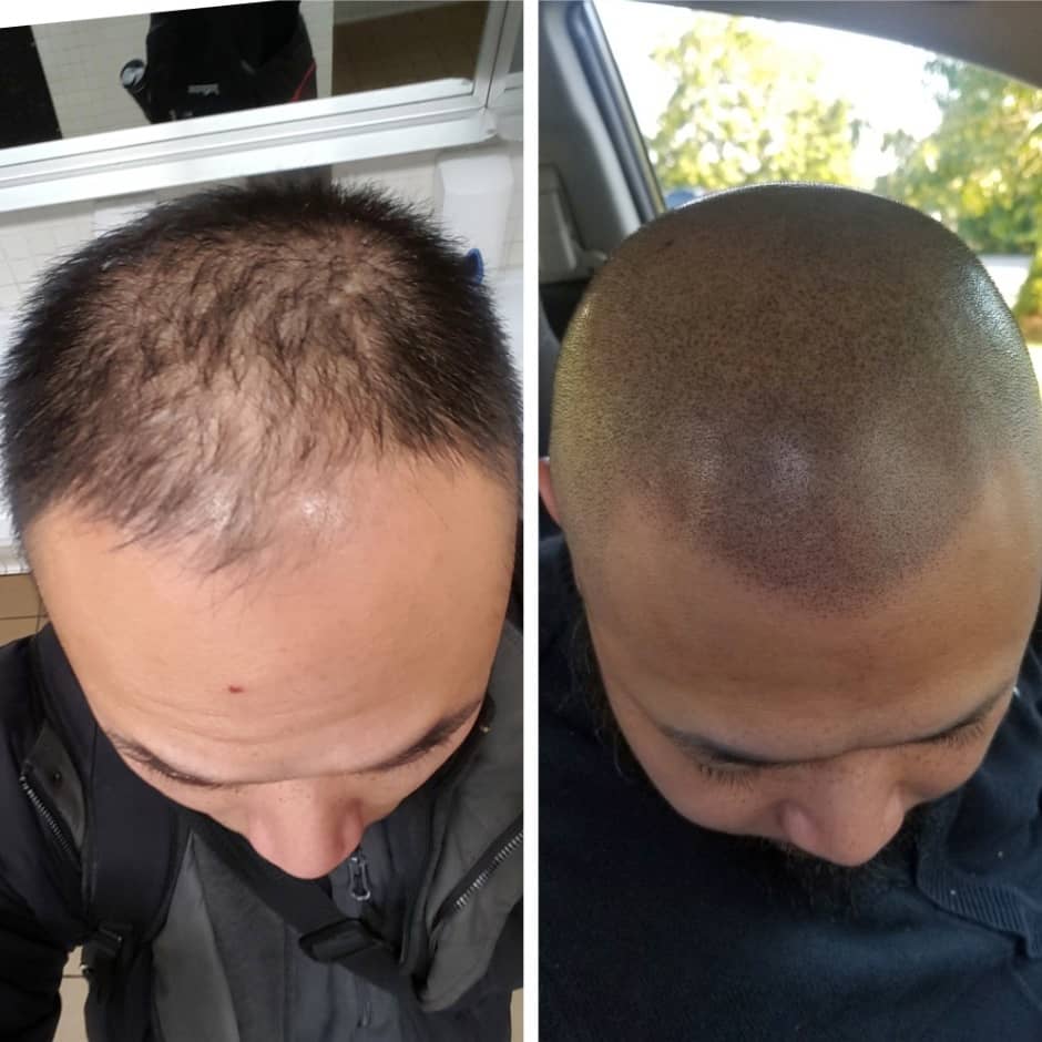 The Journey from Balding to Confidence: How SMP Helped Me